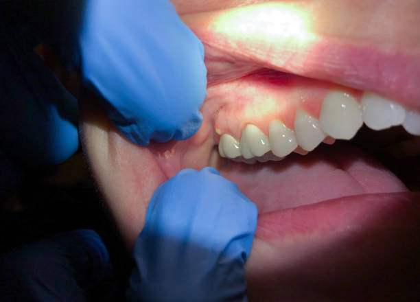 Best Emergency Denture Repair in Oak Hill, OH