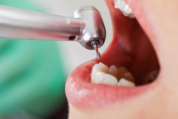 Best Emergency Tooth Extraction in Oak Hill, OH
